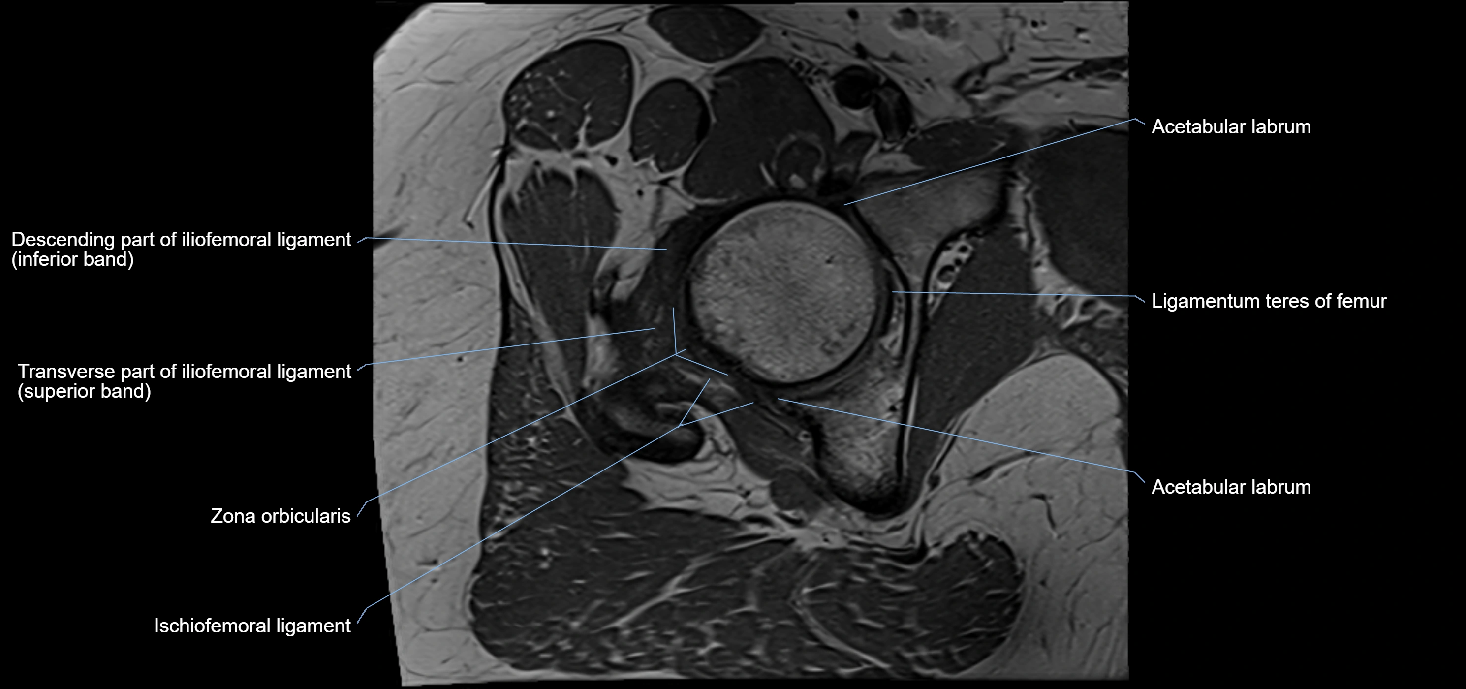 Hip ligament anatomy axial 3T MRI image -img-13001-00017.webp